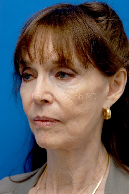 Facelift Before and After | Sayah Institute