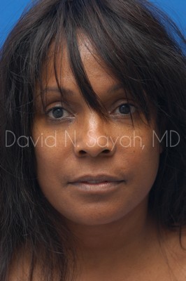 Facelift Before and After | Sayah Institute