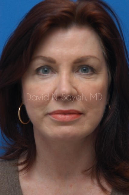 Facelift Before and After | Sayah Institute