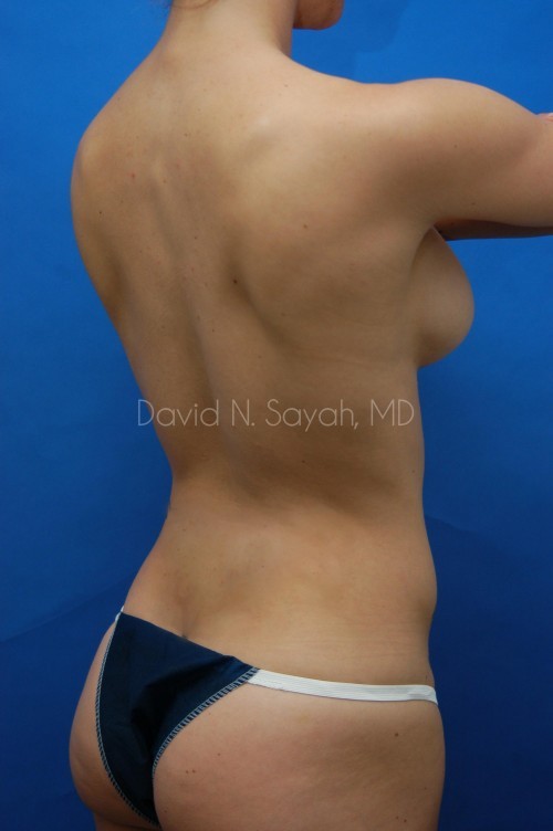 Fat Injection Breast Before and After | Sayah Institute