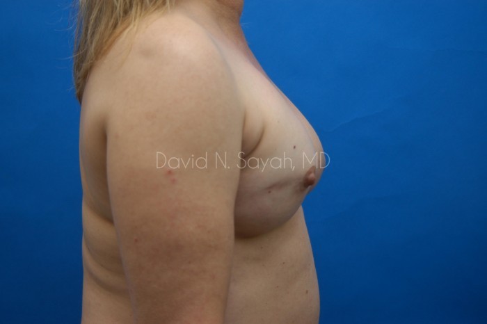 Fat Injection Breast Before and After | Sayah Institute