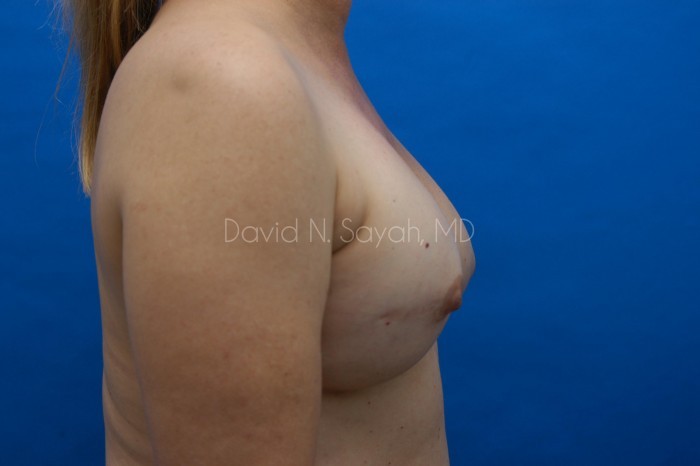 Fat Injection Breast Before and After | Sayah Institute