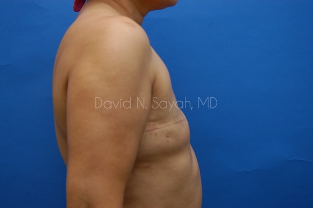 Fat Injection Breast Before and After | Sayah Institute