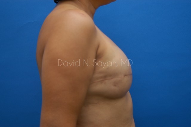 Fat Injection Breast Before and After | Sayah Institute