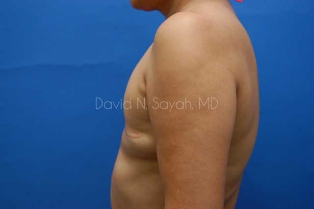 Fat Injection Breast Before and After | Sayah Institute