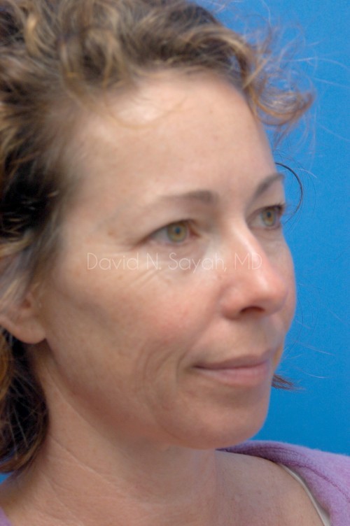 Fat Injection Face Before and After | Sayah Institute