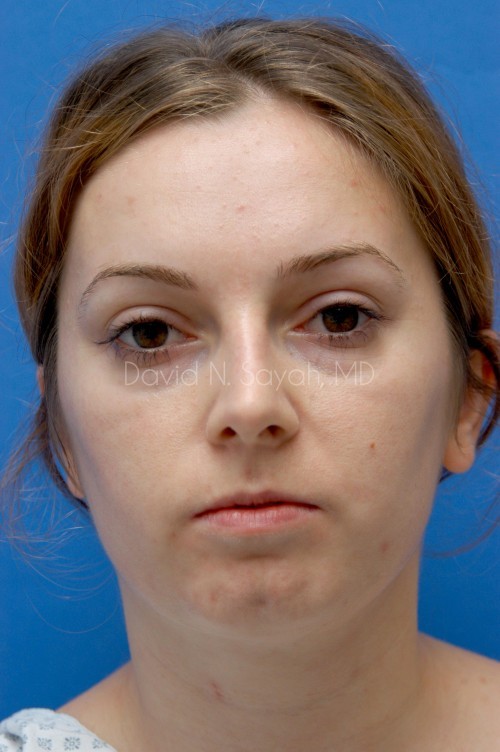 Fat Injection Face Before and After | Sayah Institute