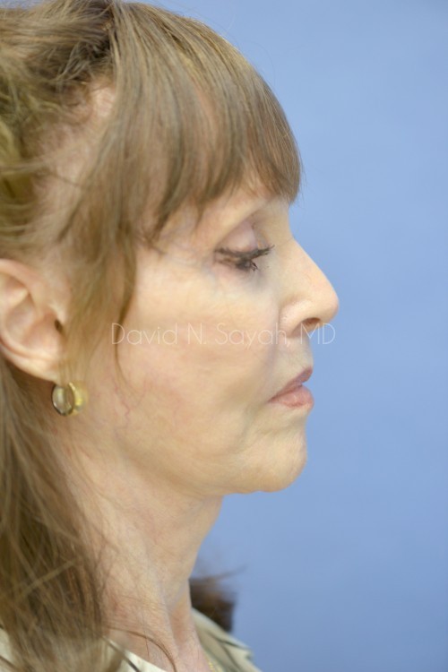 Fat Injection Face Before and After | Sayah Institute