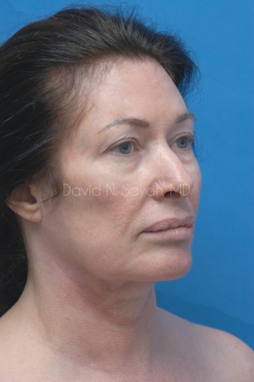 Fat Injection Face Before and After | Sayah Institute