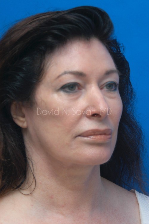 Fat Injection Face Before and After | Sayah Institute