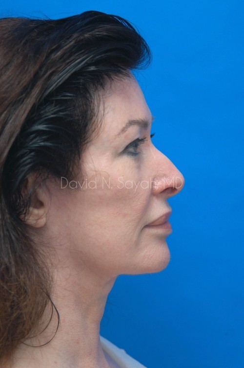 Fat Injection Face Before and After | Sayah Institute