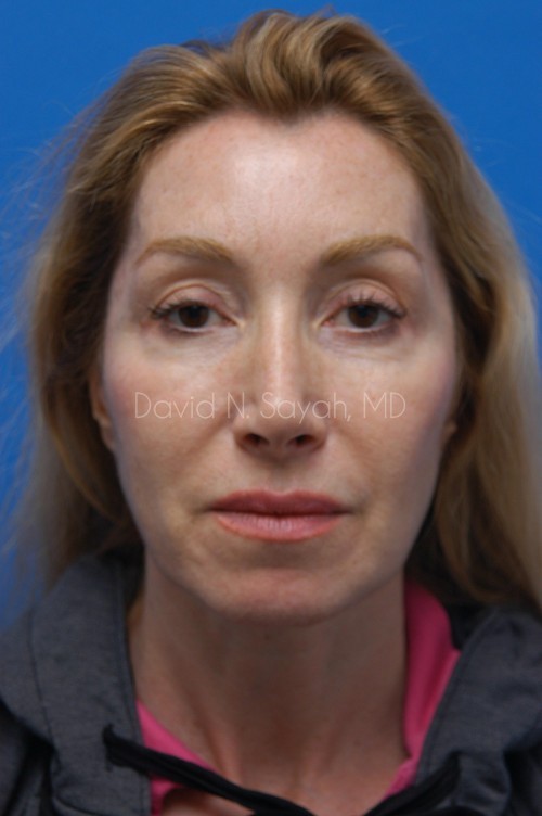 Fat Injection Face Before and After | Sayah Institute