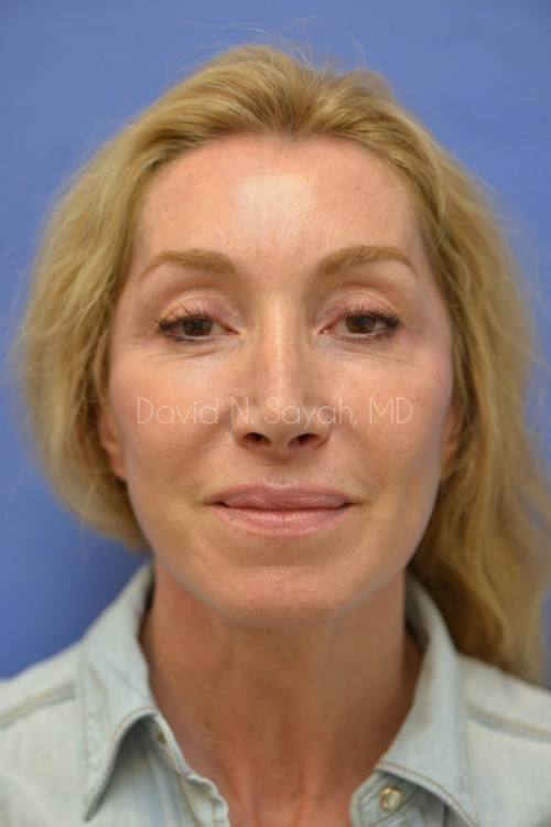 Fat Injection Face Before and After | Sayah Institute