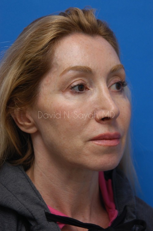 Fat Injection Face Before and After | Sayah Institute