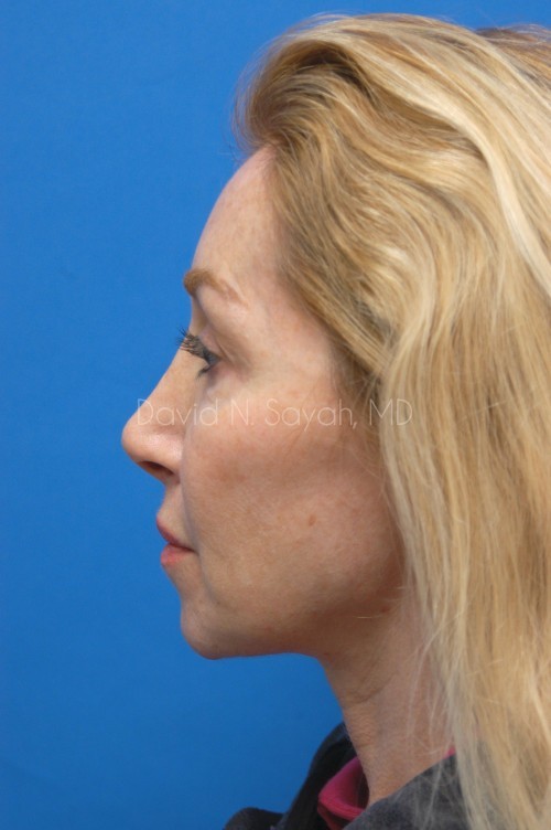 Fat Injection Face Before and After | Sayah Institute
