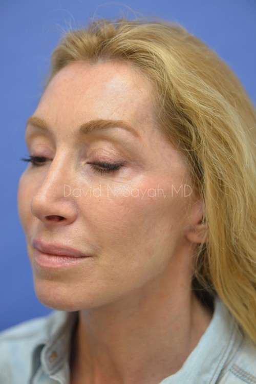 Fat Injection Face Before and After | Sayah Institute