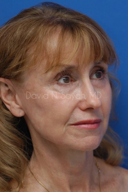 Fat Injection Face Before and After | Sayah Institute