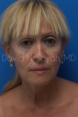 Fat Injection Face Before and After | Sayah Institute