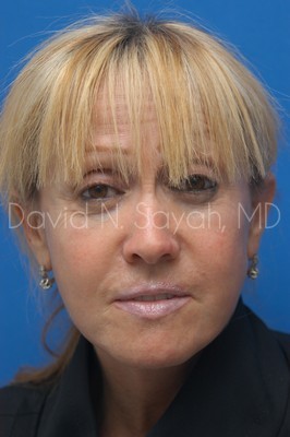 Fat Injection Face Before and After | Sayah Institute