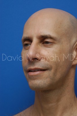 Fat Injection Face Before and After | Sayah Institute