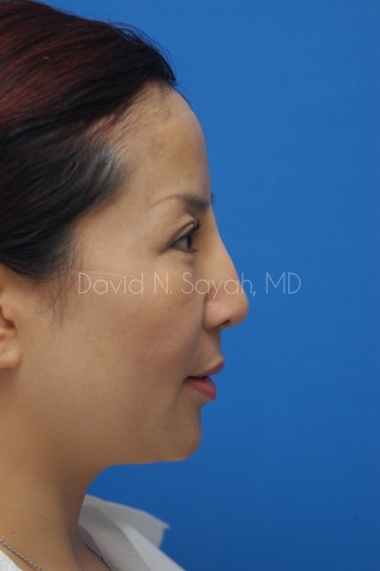 Fat Injection Face Before and After | Sayah Institute