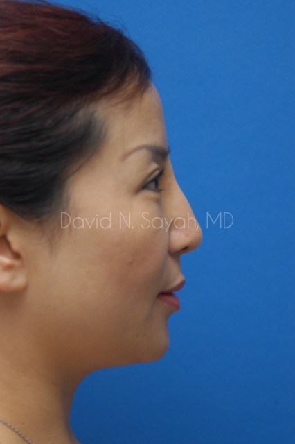 Fat Injection Face Before and After | Sayah Institute