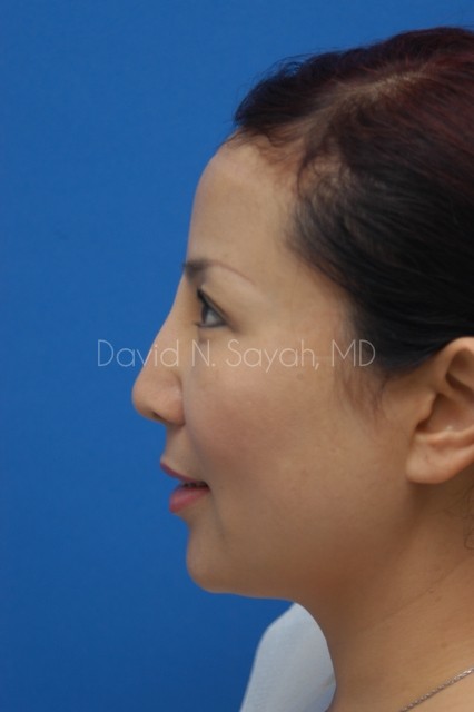 Fat Injection Face Before and After | Sayah Institute