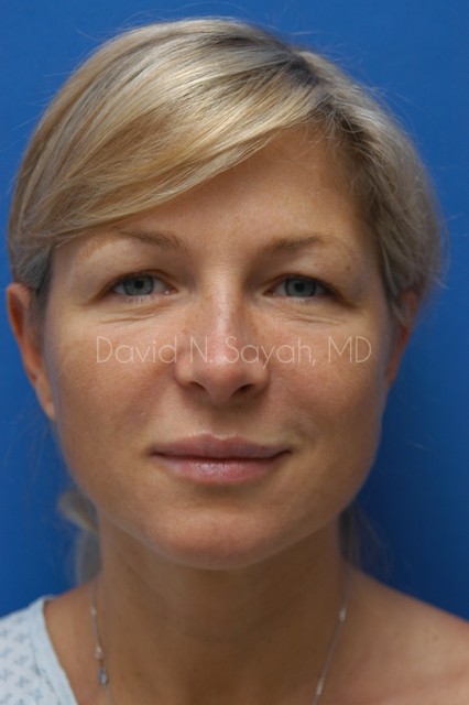 Fat Injection Face Before and After | Sayah Institute