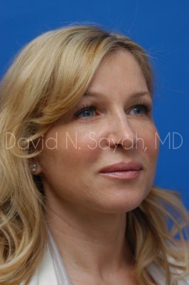 Fat Injection Face Before and After | Sayah Institute