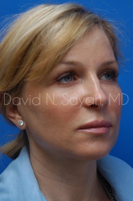 Fat Injection Face Before and After | Sayah Institute