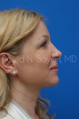 Fat Injection Face Before and After | Sayah Institute