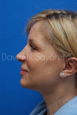 Fat Injection Face Before and After | Sayah Institute