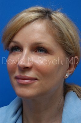 Fat Injection Face Before and After | Sayah Institute