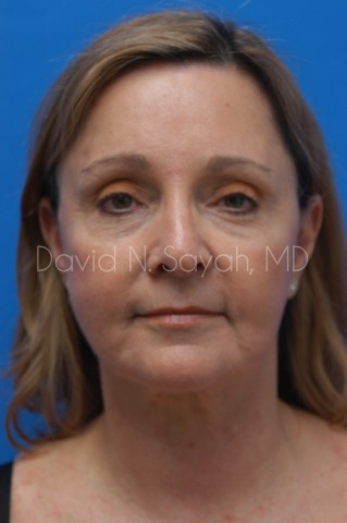 Fat Injection Face Before and After | Sayah Institute