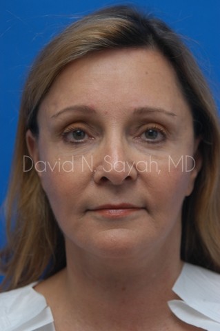 Fat Injection Face Before and After | Sayah Institute