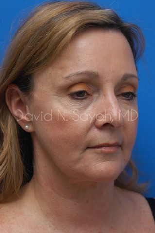 Fat Injection Face Before and After | Sayah Institute