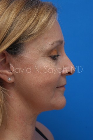 Fat Injection Face Before and After | Sayah Institute