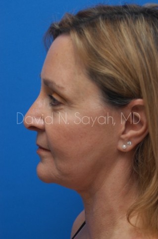 Fat Injection Face Before and After | Sayah Institute