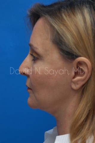 Fat Injection Face Before and After | Sayah Institute