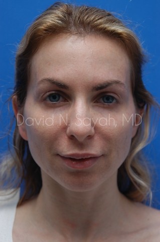 Fat Injection Face Before and After | Sayah Institute