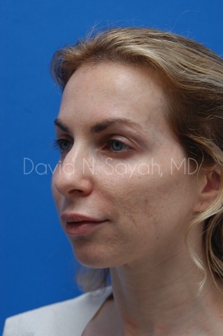 Fat Injection Face Before and After | Sayah Institute