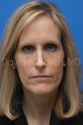 Fat Injection Face Before and After | Sayah Institute