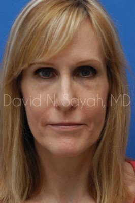 Fat Injection Face Before and After | Sayah Institute