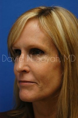 Fat Injection Face Before and After | Sayah Institute