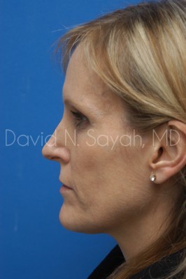 Fat Injection Face Before and After | Sayah Institute