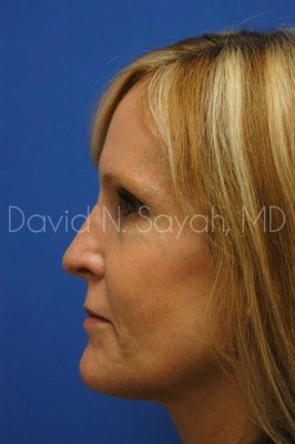 Fat Injection Face Before and After | Sayah Institute