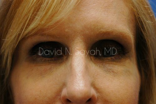 Fat Injection Face Before and After | Sayah Institute