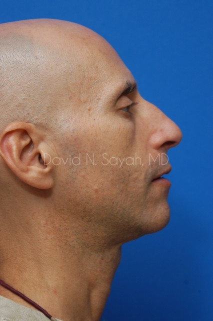 Fat Injection Face Before and After | Sayah Institute