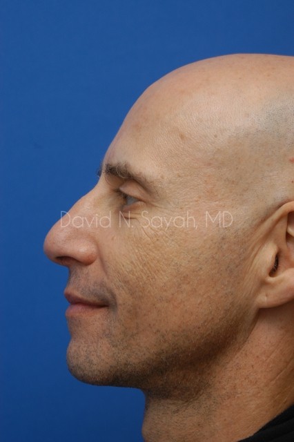 Fat Injection Face Before and After | Sayah Institute