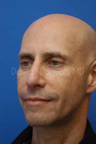 Fat Injection Face Before and After | Sayah Institute